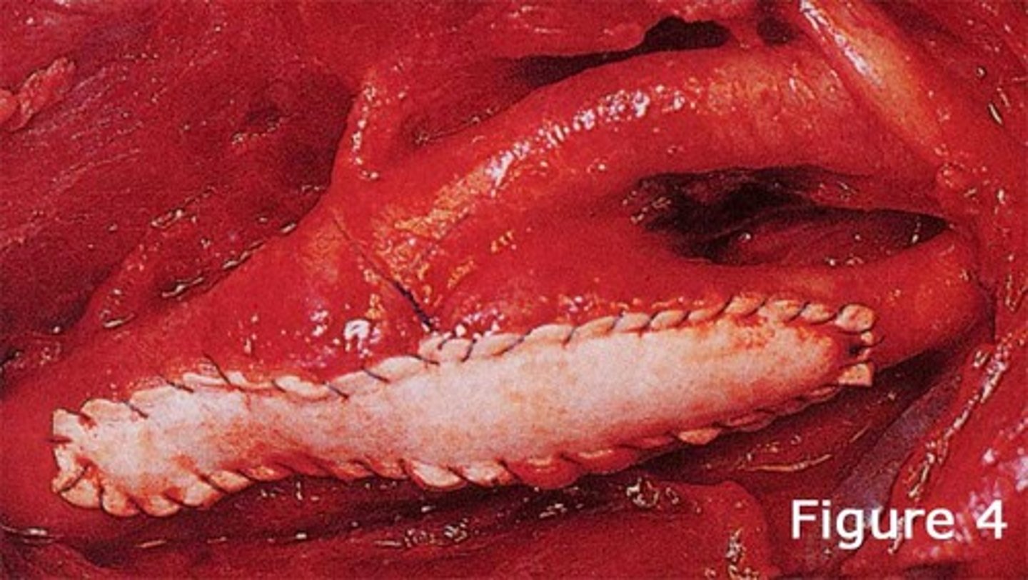 <p>used to repair atrial, ventricular septal defects in pediatric patients</p>