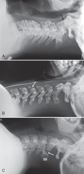 <ul><li><p>structures shown: </p><ul><li><p>seven cervical vertebrae</p></li><li><p>base of skull</p></li><li><p>soft tissue of neck</p></li></ul></li><li><p>evaluation criteria:</p><ul><li><p>all seven cervical vertebrae</p></li><li><p>neck extended when possible, so mandibular rami are no superimposing C1 or C2</p></li></ul></li><li><p>C4 centered</p></li><li><p>superimposed posterior margins of each vertebral body</p></li></ul><p></p>