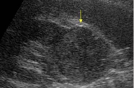 <ul><li><p>echogenic <mark data-color="yellow" style="background-color: yellow; color: inherit;">shades of gray</mark> representing tissue (low-level internal echoes)</p></li><li><p>? irregular borders</p></li><li><p>? weak posterior borders</p></li><li><p><mark data-color="yellow" style="background-color: yellow; color: inherit;">poorly defined interface</mark> between mass and kidney</p></li><li><p><u>poor through-transmission</u></p></li></ul><p></p>