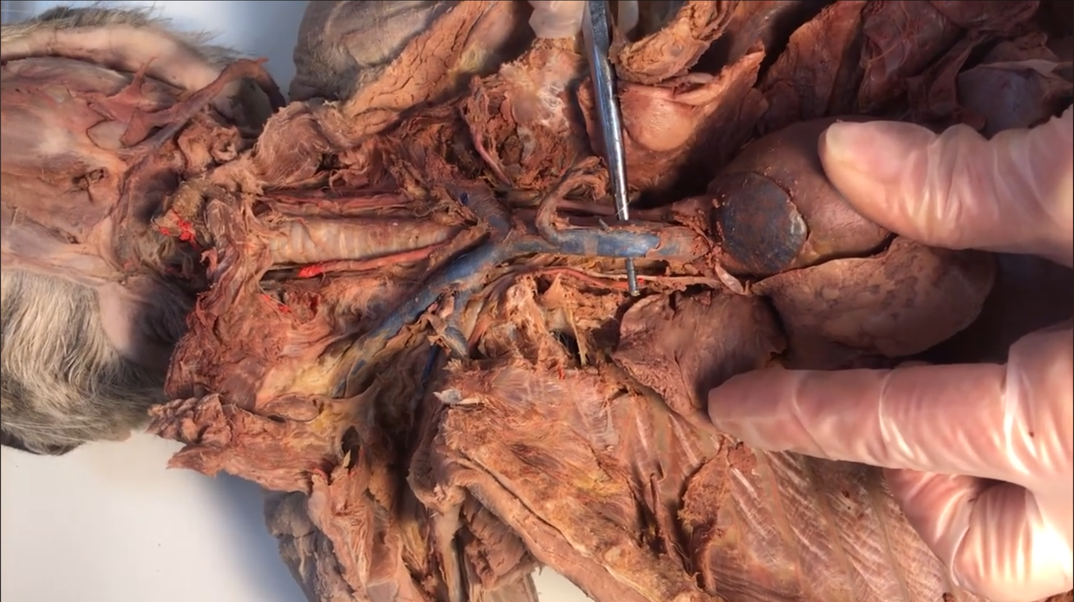 <p>What vein is this </p>