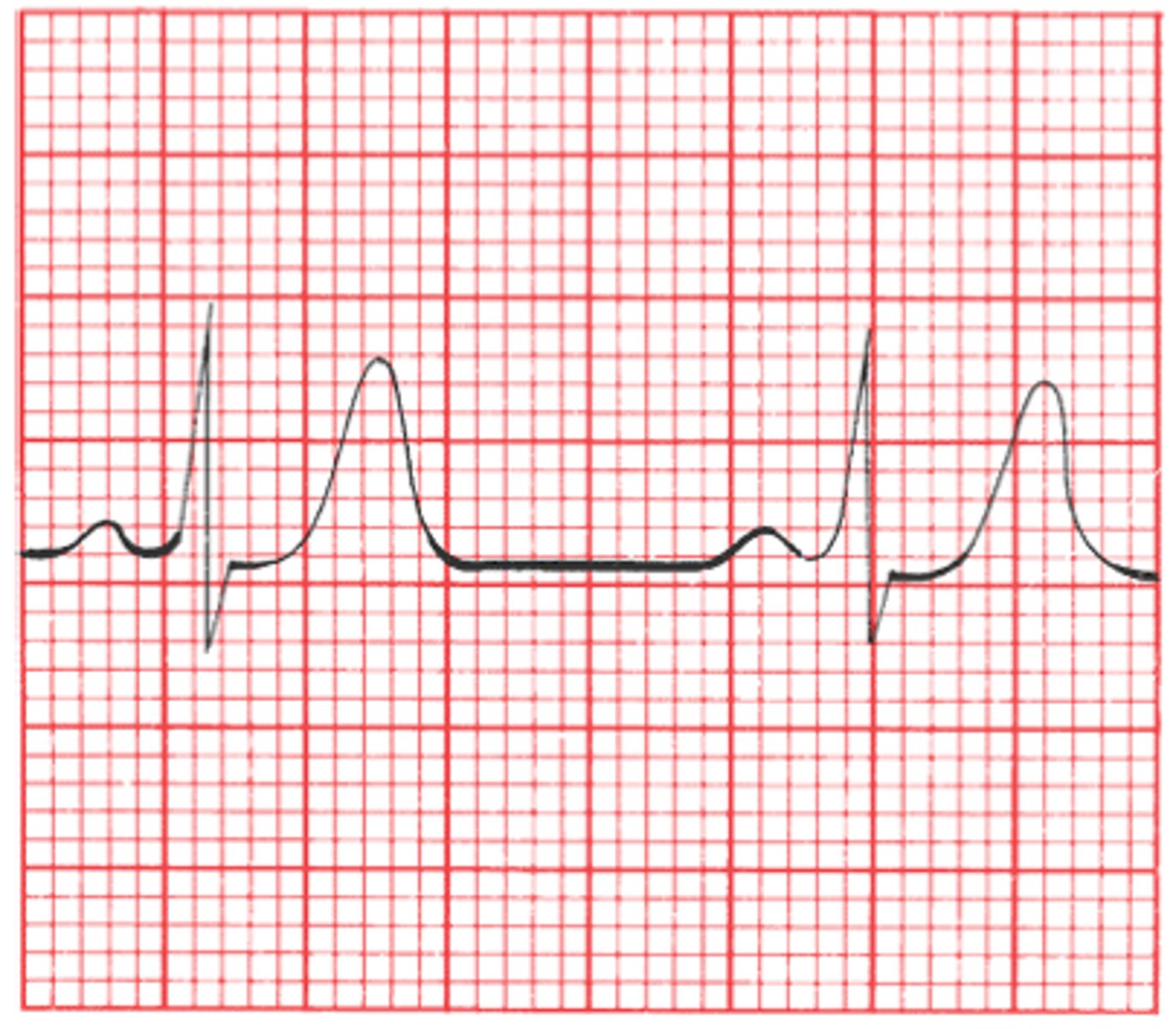 <p>What is being shown in this EKG? What causes this?</p>