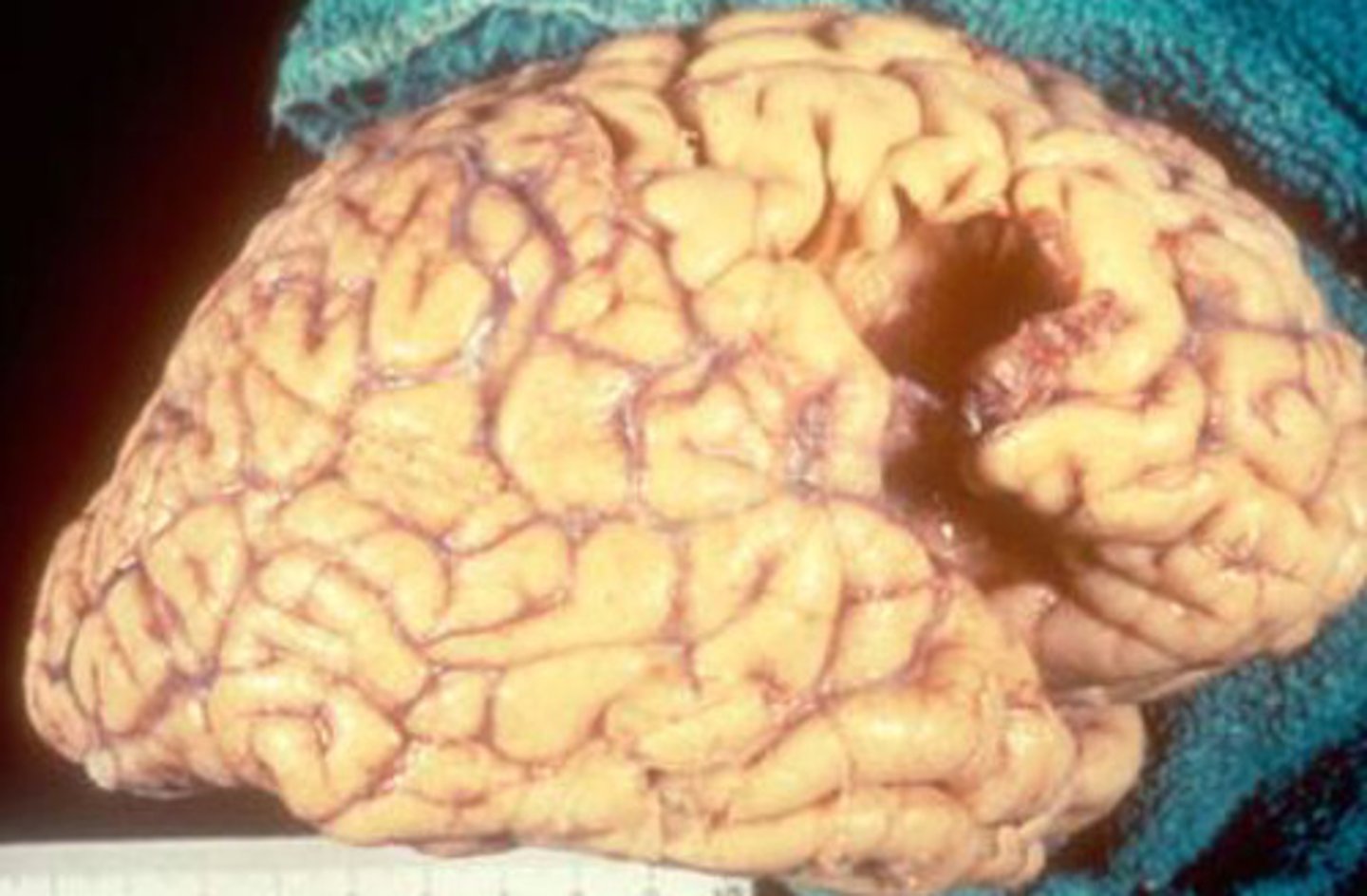 <p>What kind of necrosis is shown?</p>