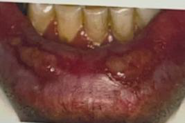 <ul><li><p>Identify the disease</p></li><li><p>Other name</p></li><li><p>Clinical Features|</p></li><li><p>Oral manifestation</p></li><li><p>Treatment</p></li></ul><p></p>