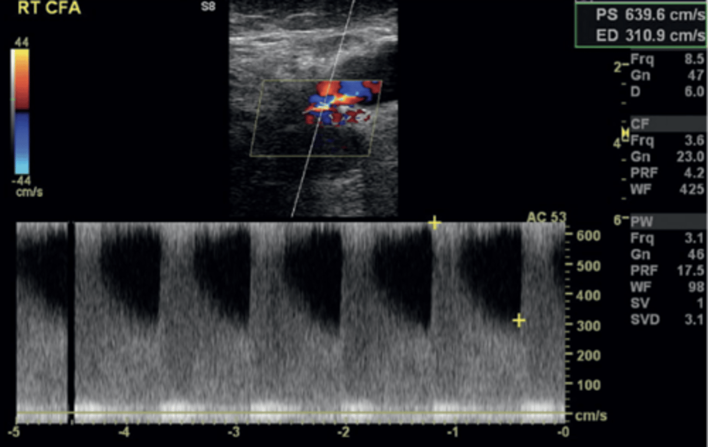 <p>Continuous diastolic flow with loss of diastolic reversal</p><p>Peak velocity > 180 cm/sec or < 45 cm/sec</p><p>Stenotic profile</p>