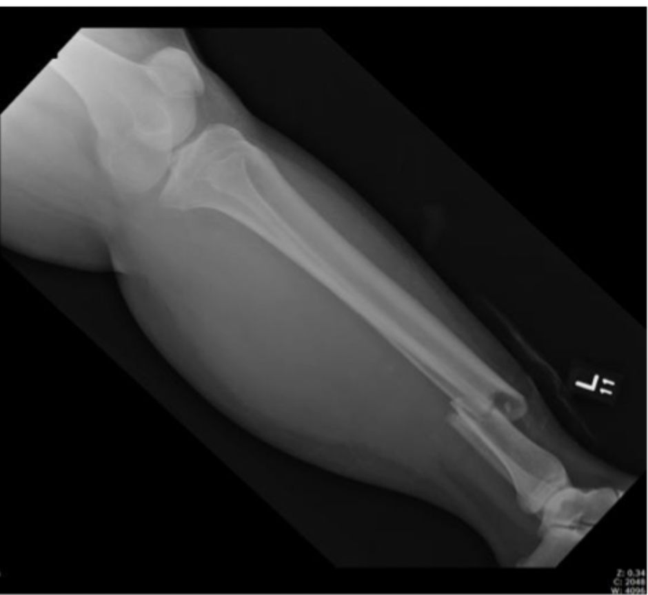 <p>MOI for tibia shaft fractures</p>