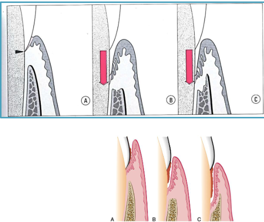 <ol><li><p><strong>normal</strong>: apical termination of junctional epithelium is at CEJ</p></li><li><p><strong>supraboney</strong>: proliferating pocket epithelium + remnant of junction epithelium persists </p></li><li><p><strong>infraboney</strong>: extends beyond alveolar crest </p></li></ol><p></p>