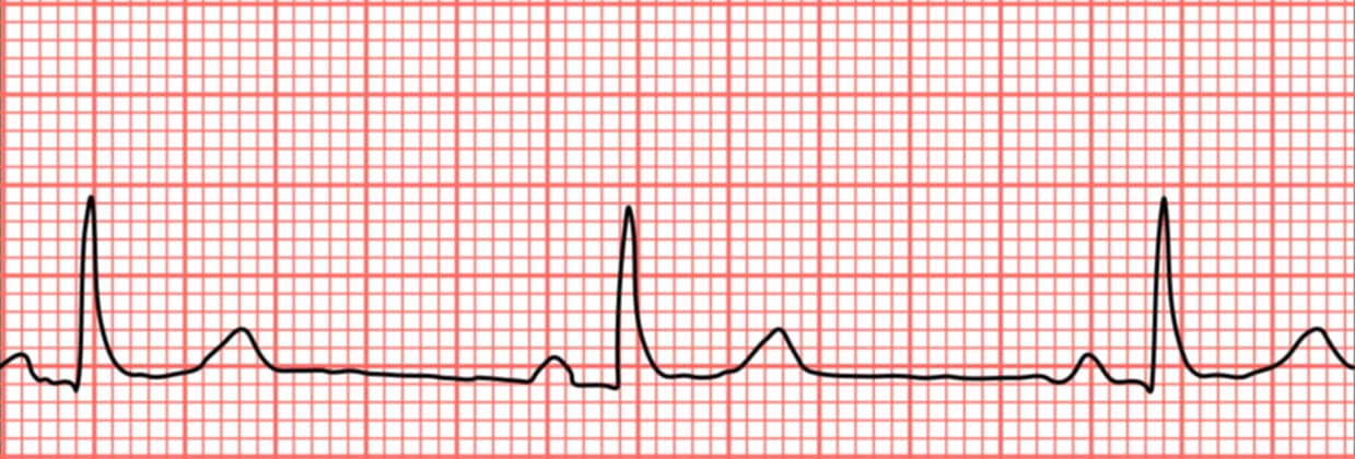 <p>what rhythm is shown in the ECG?</p>
