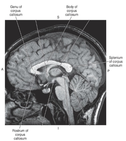 <ul><li><p>important white matter commissural tract</p></li><li><p>components: rostrum, genu, body, splenium </p></li></ul><p></p>