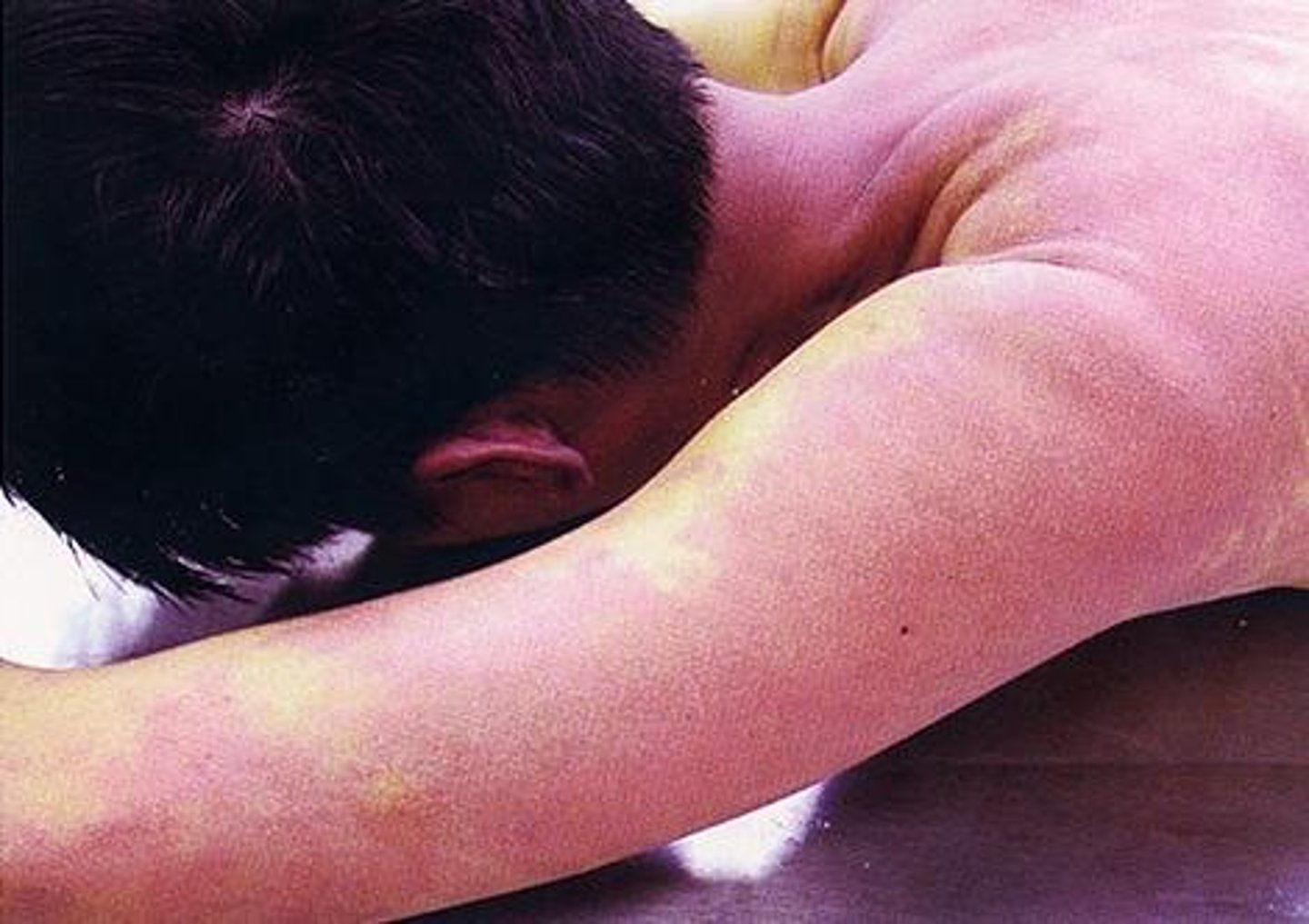 <p>Fever, allergy, infection, inflammation, heat, embarassment</p><p>- Relates to DVT, blood clots</p>