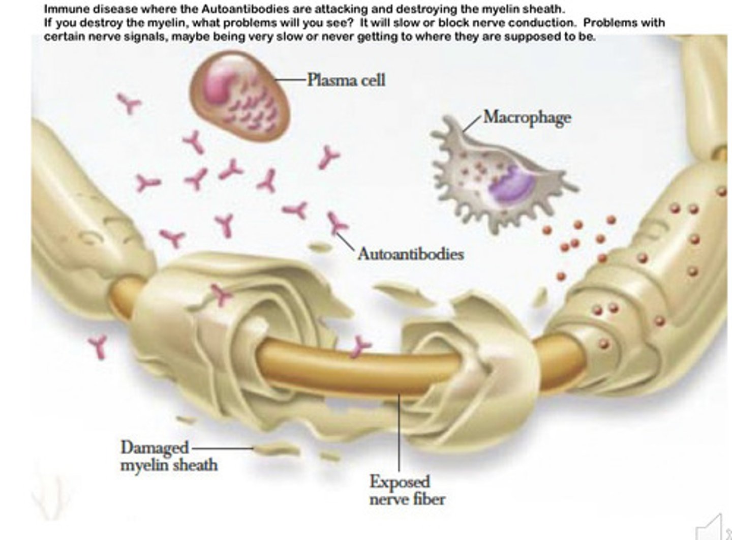 <p>slow responses:</p><p>- there will be less saltatory conduction so depolarisation needs to occur along the whole length of axon</p><p>- impulse takes a longer time to reach neuromuscular junction causing a delay in muscle contraction</p><p>jerky movement:</p><p>- ions may leak to other neurones, causing the wrong muscles to contract</p>