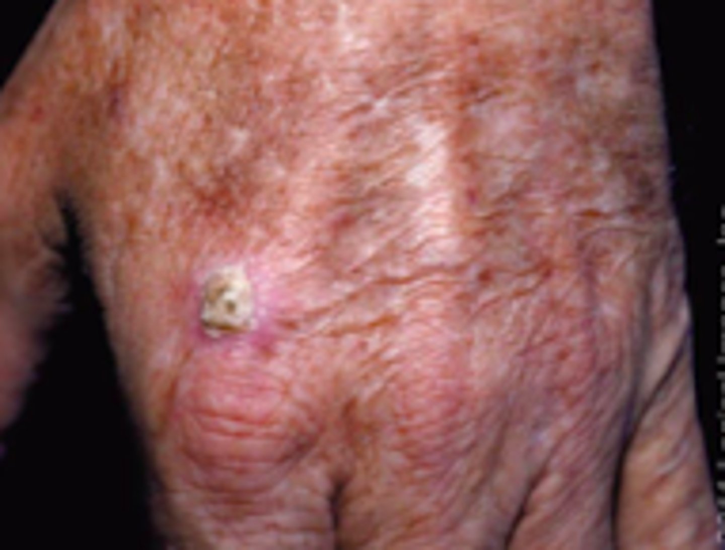 <p>Keratotic Disorders:</p><p>Objective:</p><p>Several Clinical Variants:</p><p>Classic (Common)</p><p>- Erythematous, scaly macule, papule, plaque</p><p>- Very small</p><p>Hypertrophic</p><p>- Presence of thick, adherent scale on erythematous base</p>