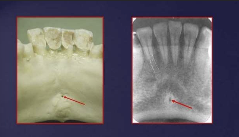 <p>lingual foramen: radiolucent ‘hole’ in centre of genial tubercles</p><p>lingual nutrients pass through this foramen</p><p>in the image you can see the mental fossa, and mental ridge</p>
