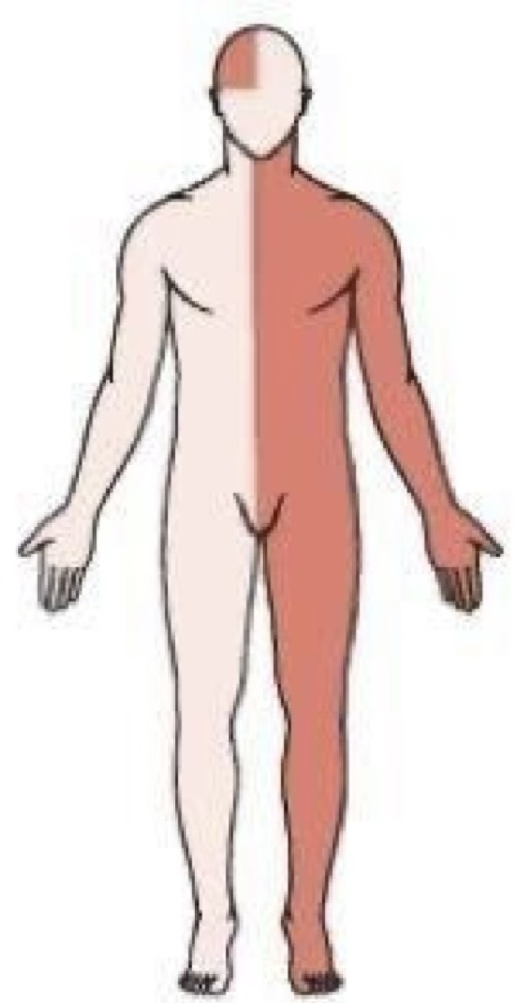 <p>Responsible for visual, spatial awareness &amp; proprioception (body awareness)</p><p class="p1">Left hemiplegia or hemiparesis </p><p class="p1">Left hemianopsia&nbsp;</p><p class="p1">Altered perception of deficits</p><p class="p1">Loss of depth perception</p><p class="p1">Poor impulse control</p><p class="p1">Unilateral neglect syndrome</p>