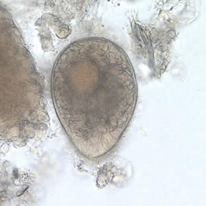 <p>This ciliated intestinal parasite measures 50 µm. What is its identity?<br><br></p><p>Cercaria of Fasciolopsis buski</p><p>Coracidium of Diphyllobothrium latum</p><p>Trophozoite of Balantidium coli</p><p>Miracidium of Schistosoma japonicum</p><p>None of the above</p>