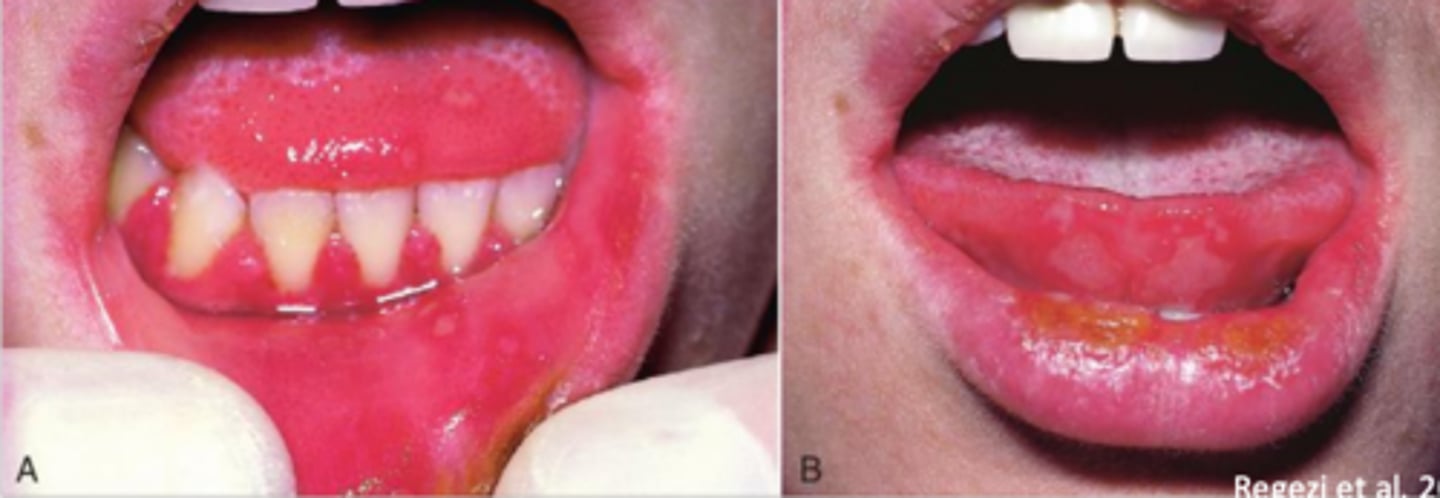 <p>primary herpes (primary herpetic gingivostomatitis)</p>