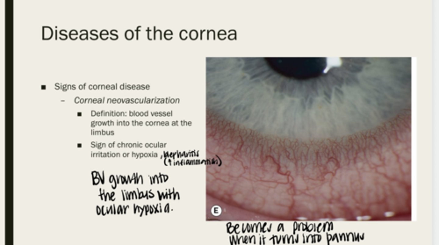 <p>blood vessel growth into the cornea at the limbus</p>