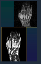 <ul><li><p>Panusul</p></li><li><p>Effusion</p></li><li><p>Bone edema</p></li><li><p>Erosions</p></li><li><p>Cysts</p></li><li><p>Tendons + contrast</p></li></ul><p></p>