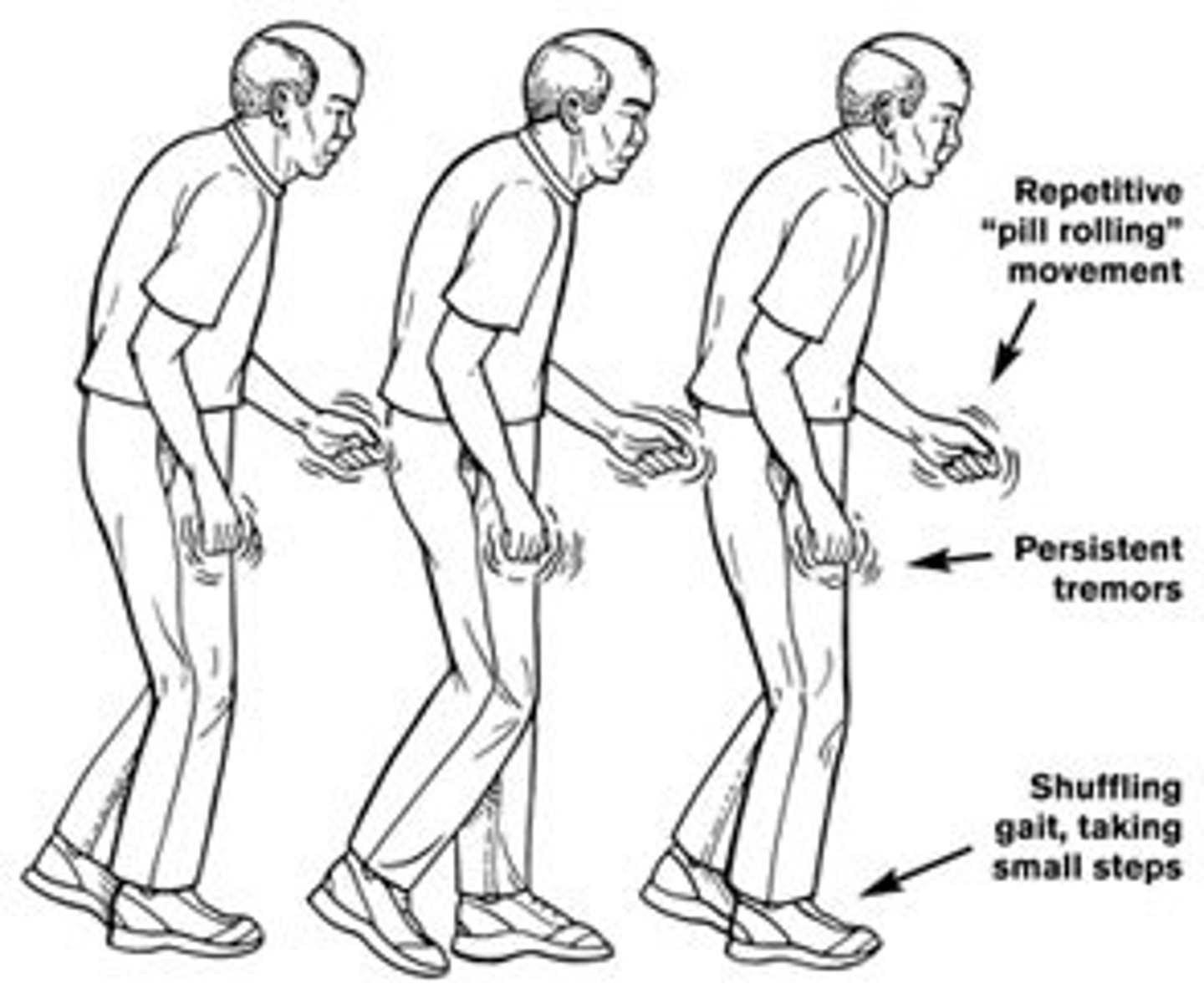<p>posture is forward</p><p>- reduced arm swing</p><p>- shuffling legs, no hs, small steps</p><p>- freezing</p>
