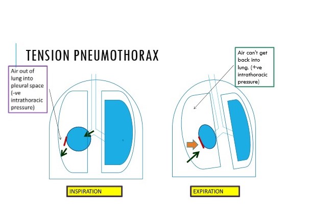 Increasing pressure in thoracic cavity

\
Hole in visceral pleura is letting air in on inspiration

\
On breathing out, air isn’t being let out :. one-way valve