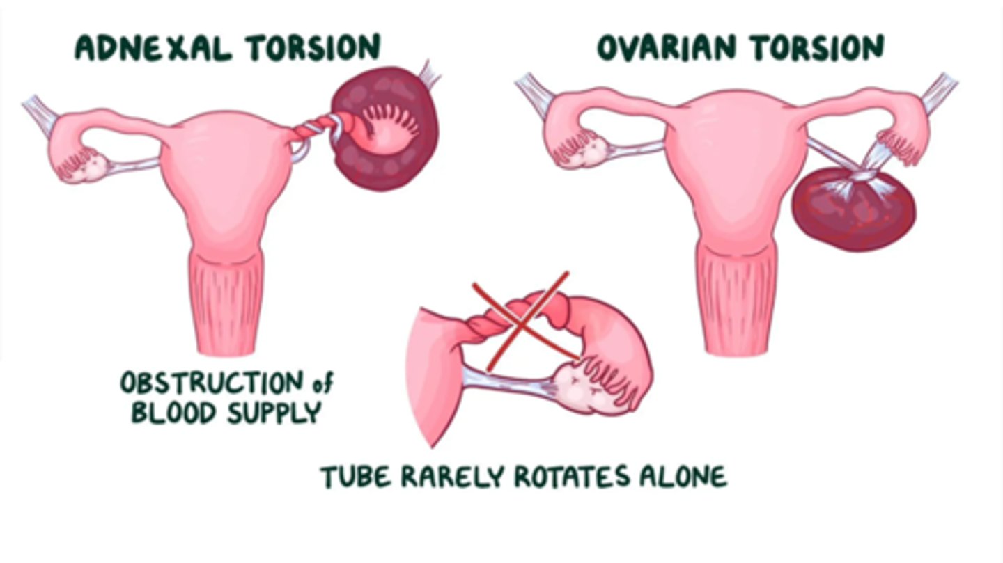 <p>Ovarian Torsion</p>