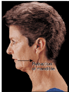 <p>Moving part of our face backward</p>
