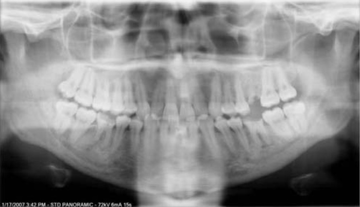 <p>A vertical radiopaque band appears in the center of the pano, obscuring the anterior teeth and nasal structures</p>