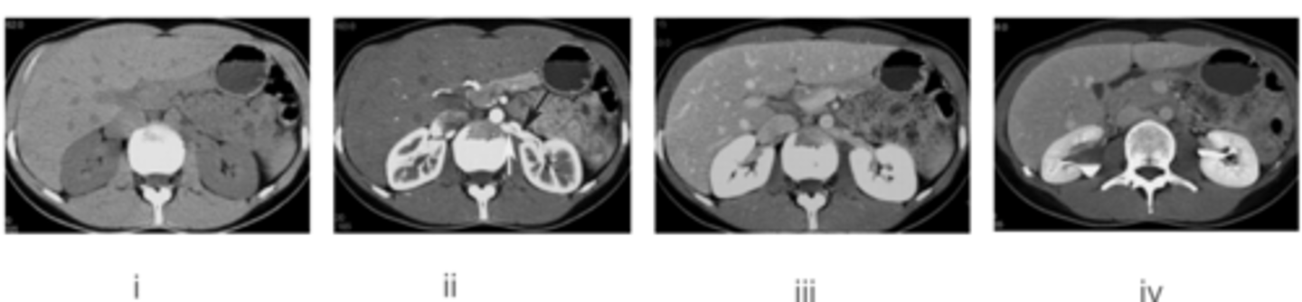 <p>i. Fase sin contraste (estructura anatómica).</p><p>ii. Fase arterial (arterias y corteza renal).</p><p>iii. Fase venosa (corteza y médula renal iluminadas).</p><p>iv. Fase de eliminación (cálices, pelvis renal, uréteres).</p>