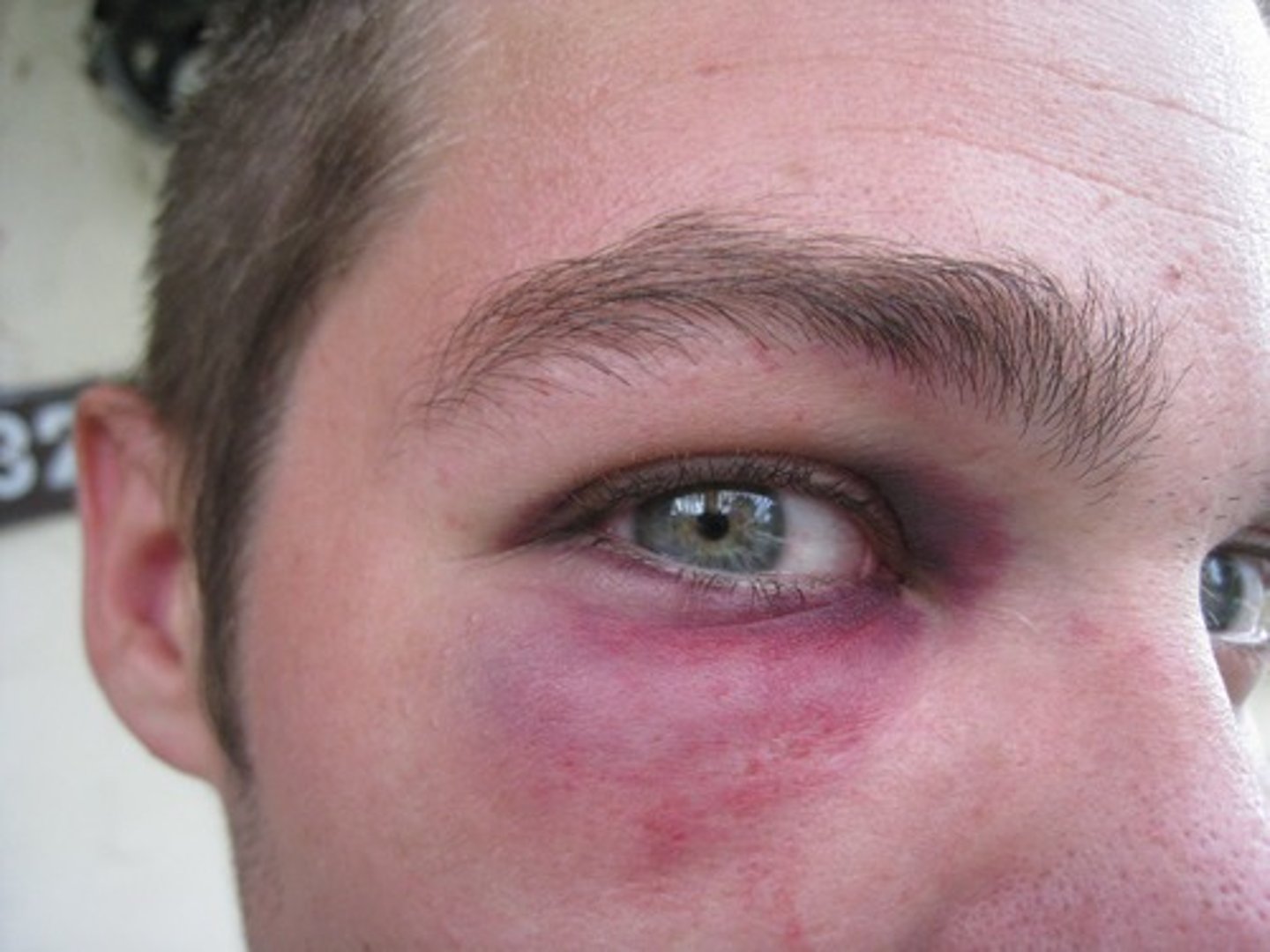 <p>blaues Auge, Veilchen</p>
