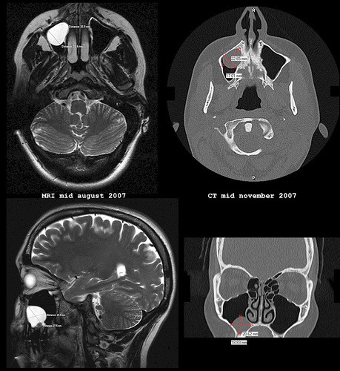 <p>CAT (CT) scans use X rays while MRI's use radio waves to create an image.</p>
