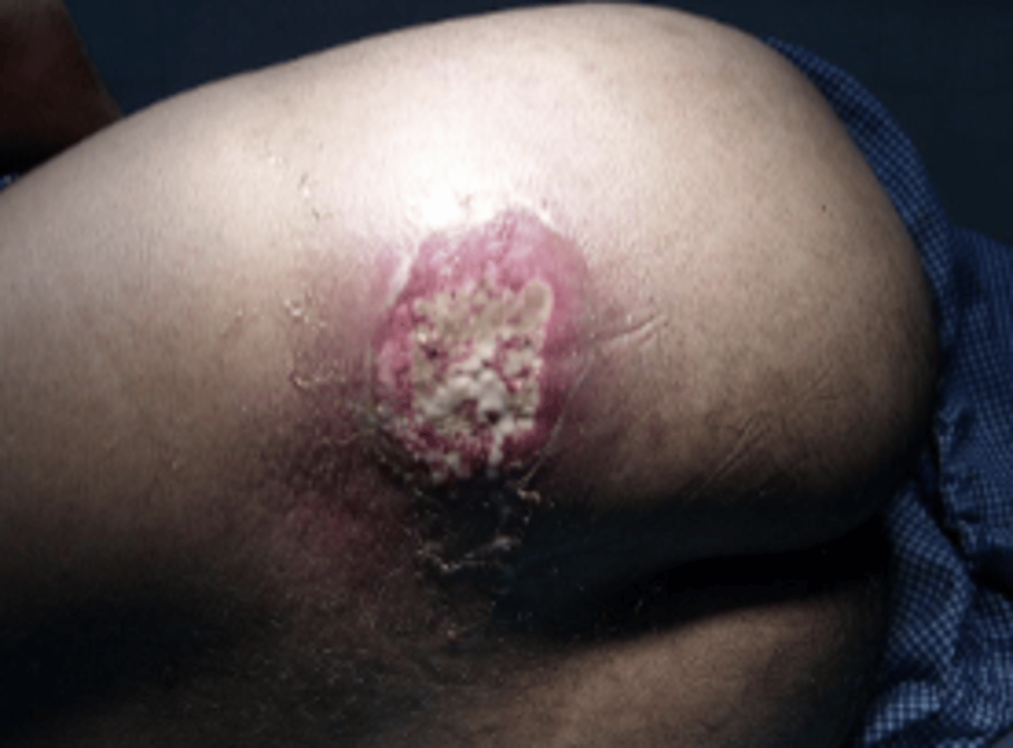 <p>cluster of furuncles with connection through sinuses</p>