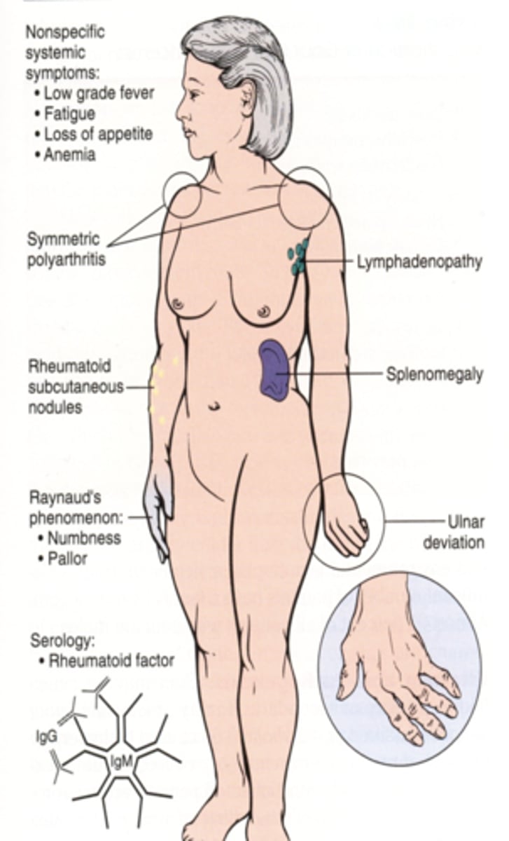 <p>-symmetric pain and swelling, prolonged morning stiffness (1 hr +), malaise, fatigue, and low-grade fever</p><p>-PIP, MCP, and thumb joints, wrist, elbow, ankle, MTP, and temporomandibular joints (jaw); the hips, knees, shoulders, and cervical spine</p>
