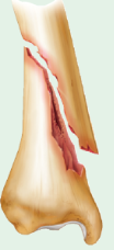 oblique fracture 