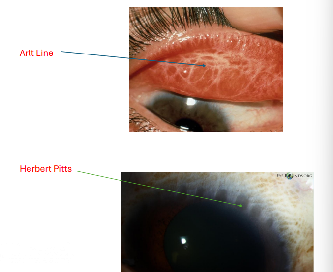 <ol><li><p><strong><u>chronic inflammation w large follicles/papillae on </u><mark data-color="yellow" style="background-color: yellow; color: inherit"><u>superior palpebral conj </u></mark><u>and scarring </u></strong></p><ol><li><p><strong><u>Arlt Line</u></strong> = horizontal scaring in conj ***************</p></li><li><p><strong><u>herberts pits</u></strong> = scarred limbal follicles **************</p></li></ol></li></ol><p>PATHONEUMONIC</p>