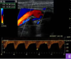 <p>Given the image, is the flow being sampled by the doppler sample gate moving towards or away from the transducer?</p>