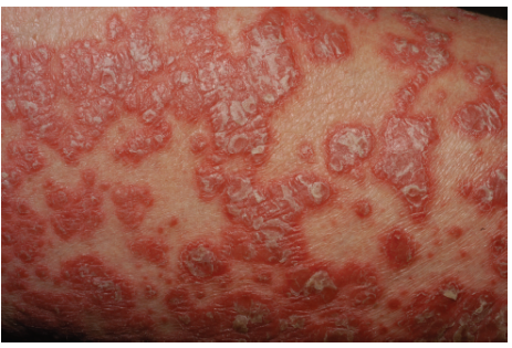 <p>psoriasis</p>