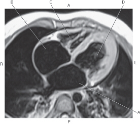 <p>In the figure below of an axial, T1-weighted MRI of the heart, which line point to the <mark data-color="blue">right atrium?</mark></p>