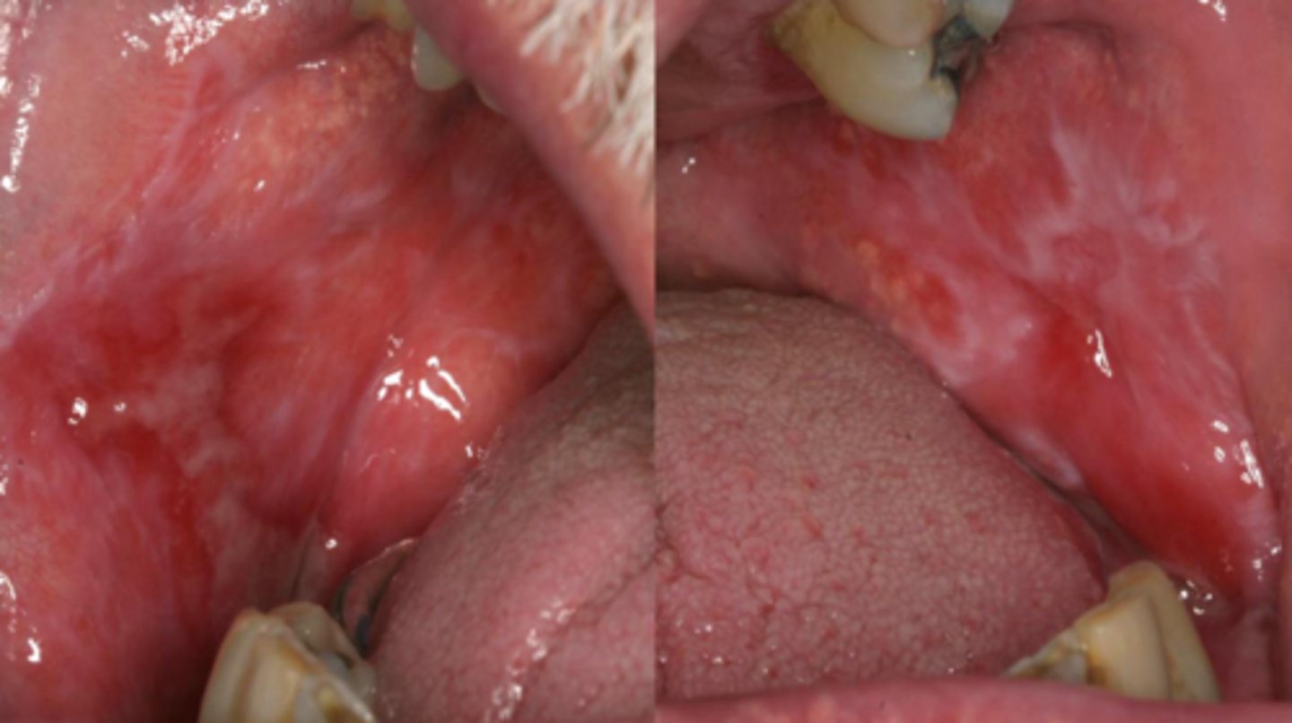 <p>bilateral; erosive lichen planus</p>