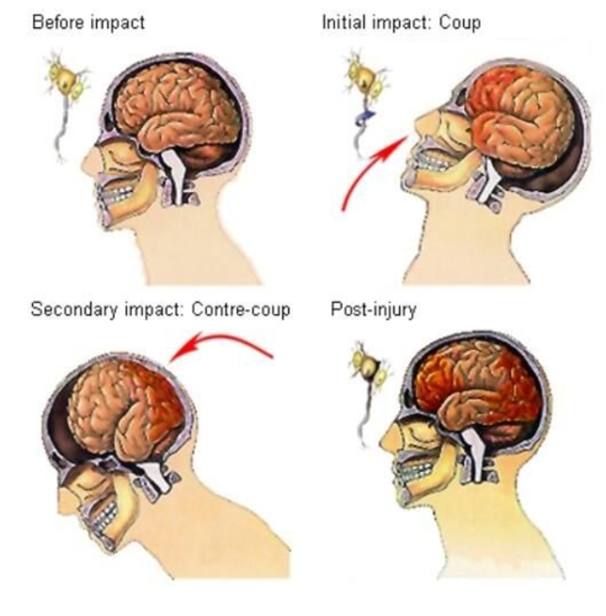 <p>Catastrophic neurological emergency characterized by rapid brain swelling after a second concussion before sxs from a previous one have resolved; YES - 60-80% mortality!!</p>