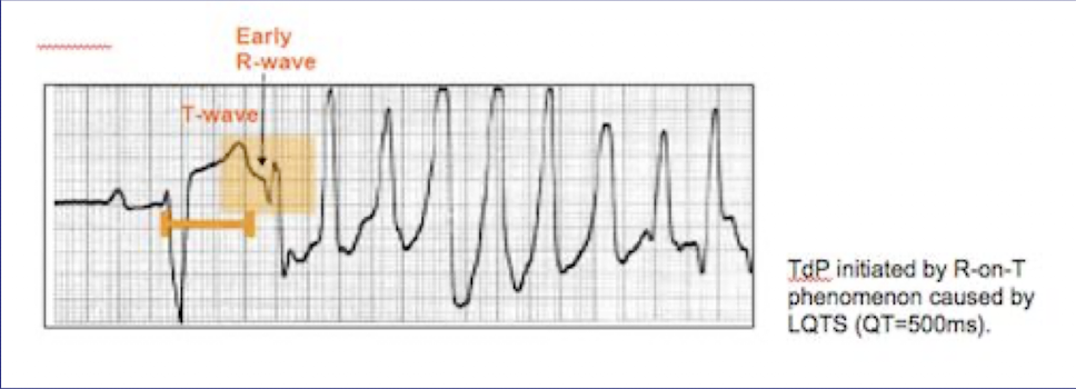 <ul><li><p><strong>Definition:</strong> A PVC occurs <strong>during the T wave</strong> of the preceding beat</p></li><li><p><strong>Why it’s dangerous:</strong> The ventricles are <strong>vulnerable during repolarization</strong> → can trigger <strong>ventricular tachycardia or ventricular fibrillation</strong></p></li><li><p><strong>Nursing action:</strong> Immediate monitoring, assess for symptoms, prepare for <strong>advanced cardiac life support (ACLS)</strong> interventions if unstable</p></li></ul><p></p>