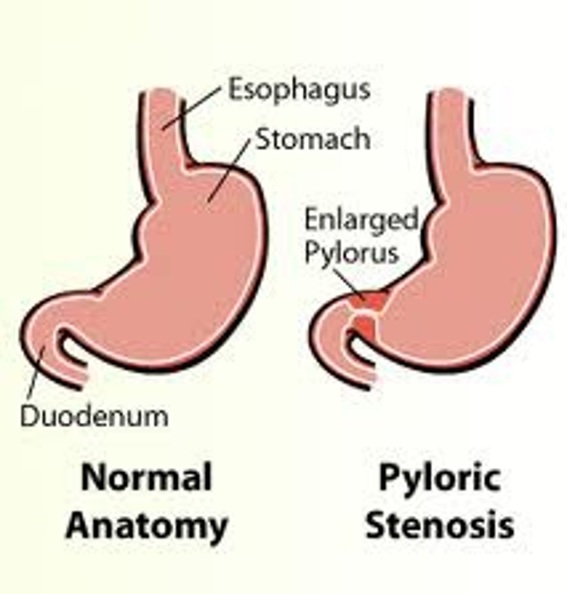<p>narrow pyloric sphincter = stomach cant empty</p><p>- Infants 2–8 weeks old</p>