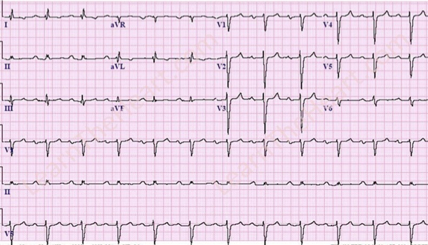 <p>What does this refer to “Prolonged PR interval, all impulses conducted”</p>