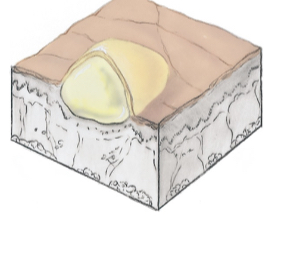 Pustule
