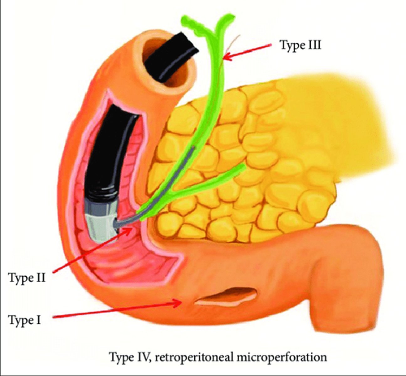 <p>duodenal perforation</p>