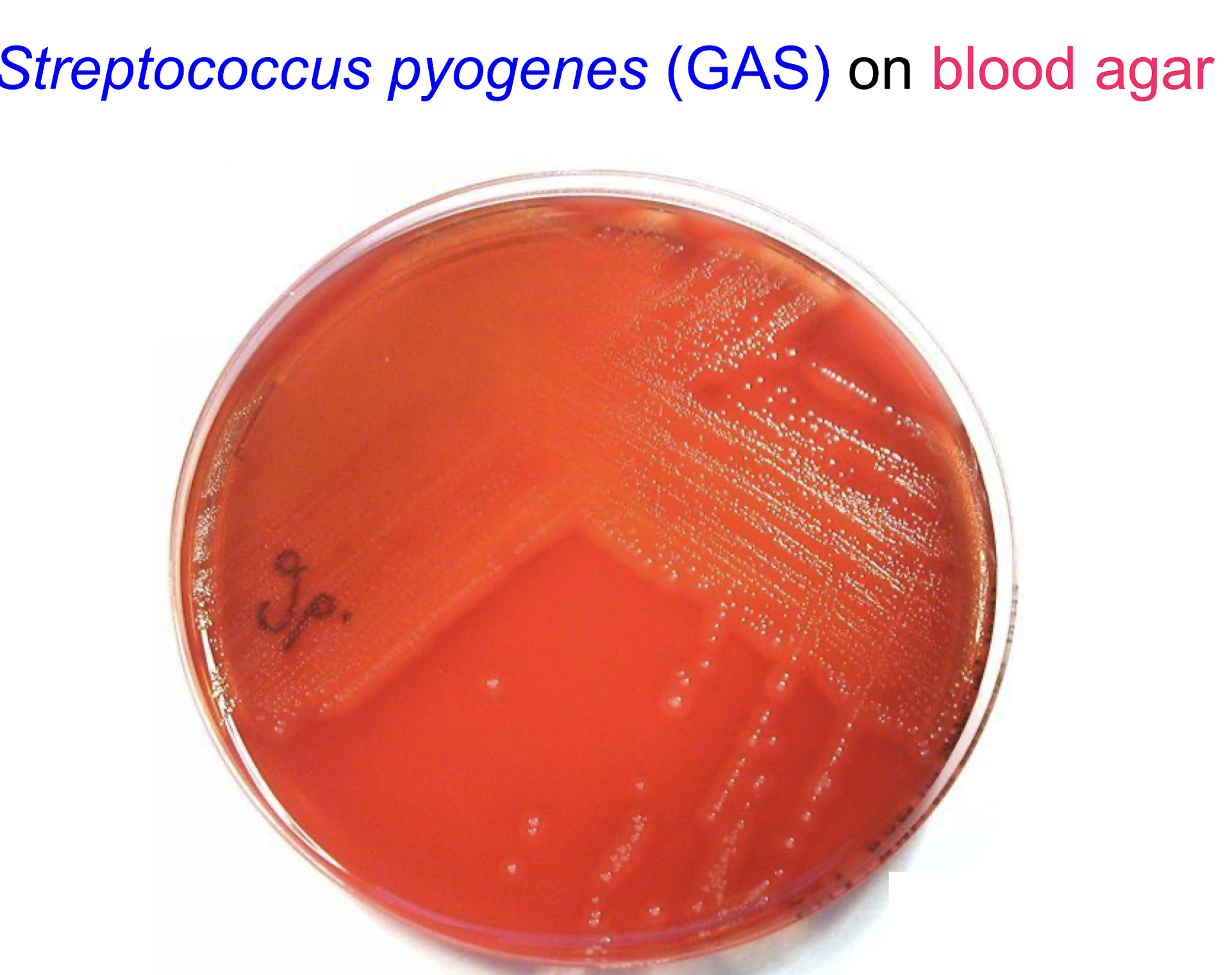 <p><strong><u>Description</u></strong></p><p><mark data-color="purple" style="background-color: purple; color: inherit;">– GP cocci in chains</mark></p><p>– facultative anaerobes</p><p>– cultured on <span style="color: red;">blood agar</span>, show as small grey/greyish white colonies</p><p>• complete / beta haemolysis</p><p><strong><u>Habitat</u></strong></p><p>– nasopharynx</p><p>– children 15-20% carriage rate (adults lower rate)</p><p><strong><u>Virulence</u></strong></p><p>-- M protein</p>