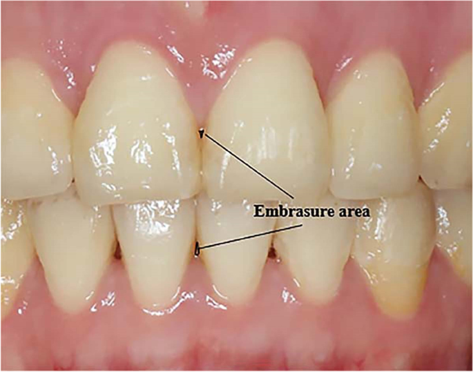 <p>Embrasures</p>