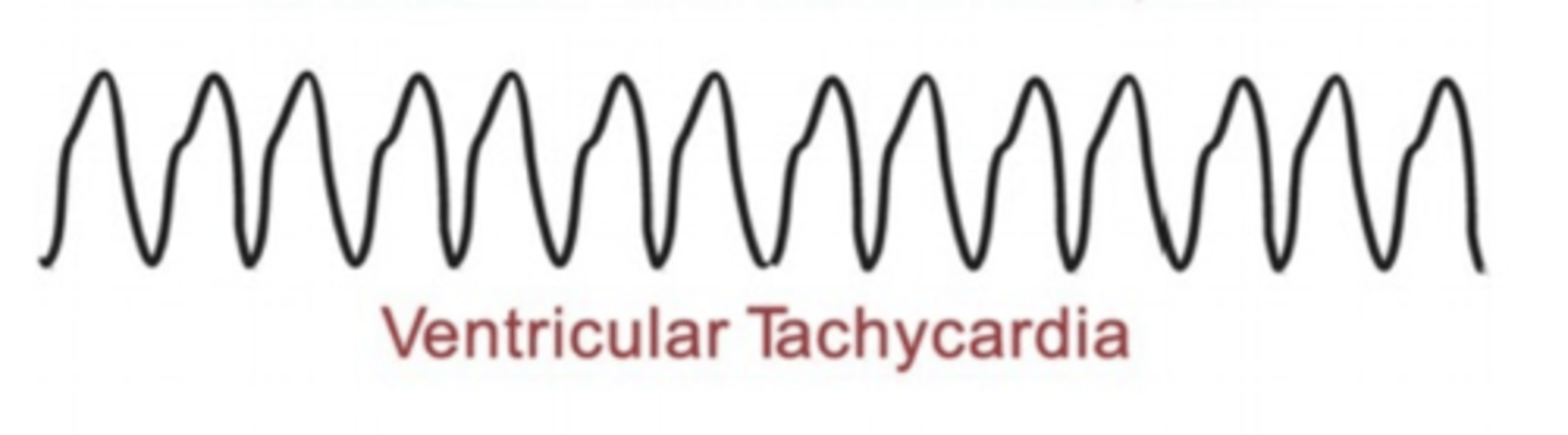 <p>Characterized by widened QRS</p>