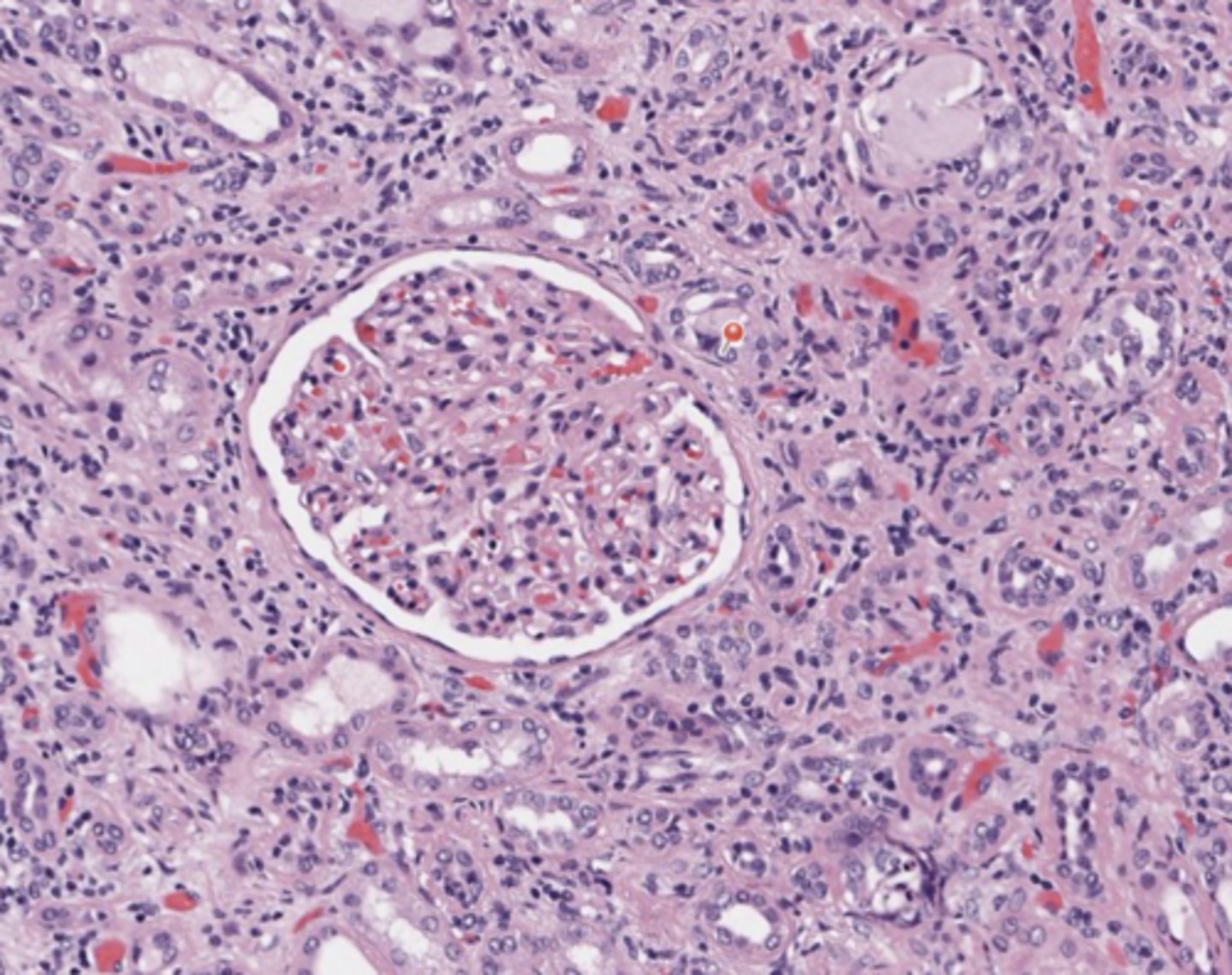 <p>Urothelial tract</p>