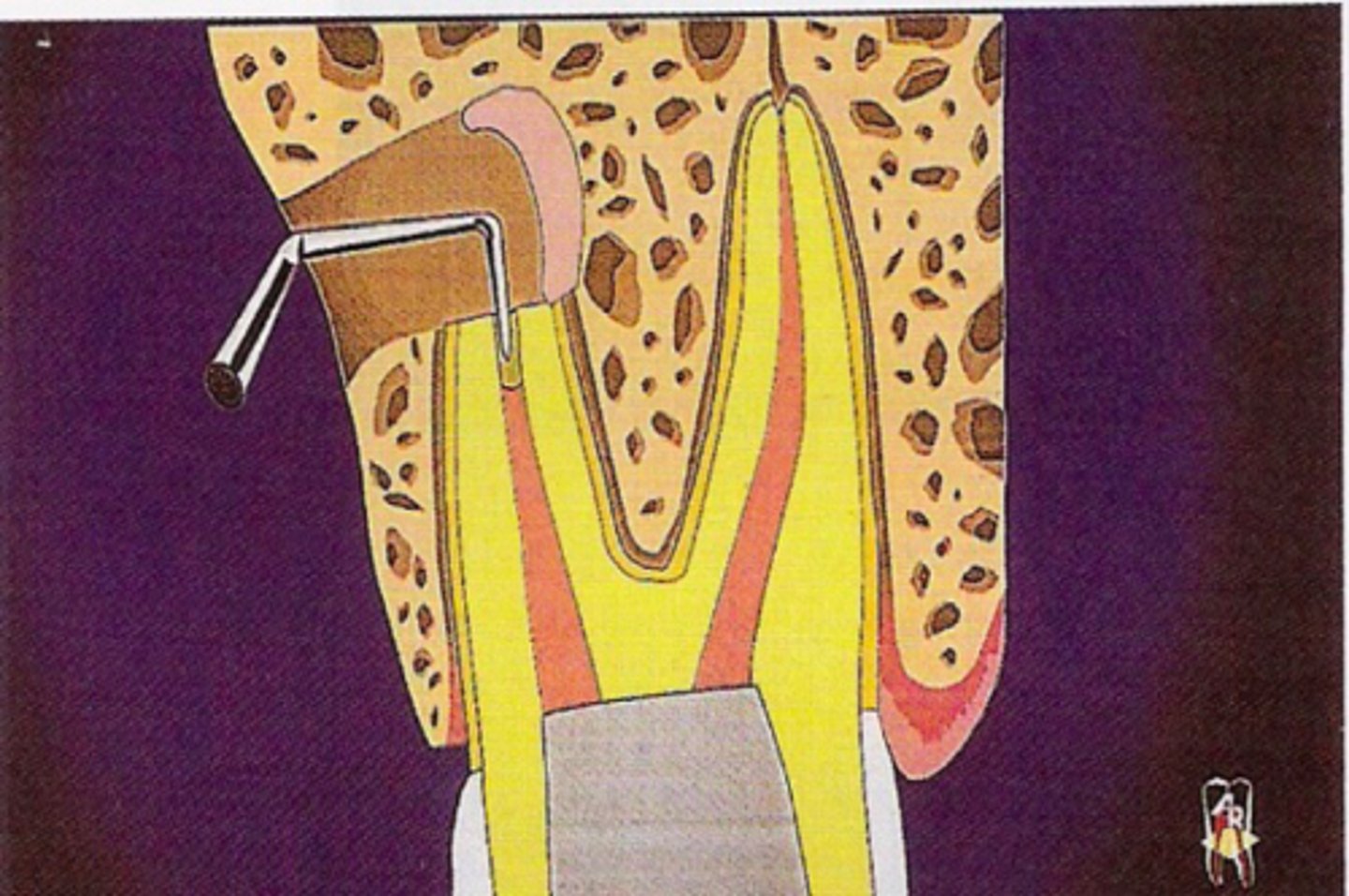 <p>ID the surgical procedure:</p><p>- Aim: To create an environment that is conducive to regeneration of the periodontium</p><p>- 1st objective: To remove the etiologic factor (via root end resection)</p><p>- 2nd objective: To prevent recontamination of PA tissues (via root end prep and fill)</p>