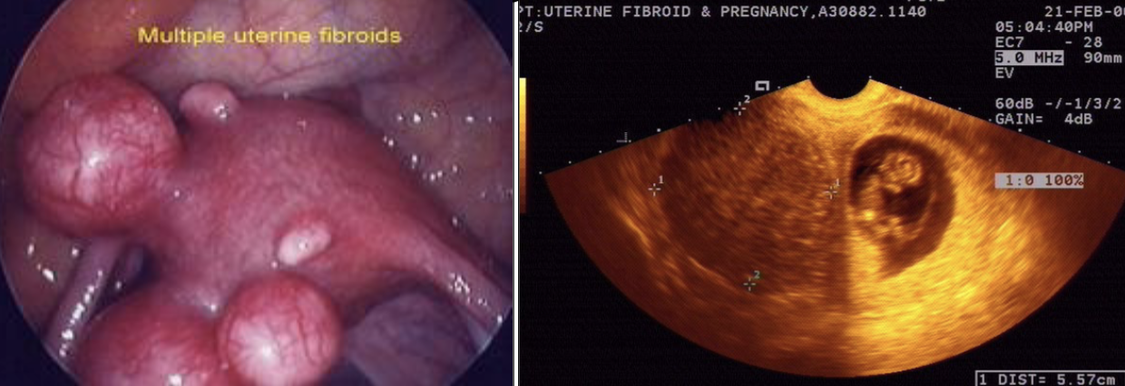 <p>uterine fibroids</p>