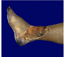 <p>Wet gangrene (Form of Necrosis)</p>